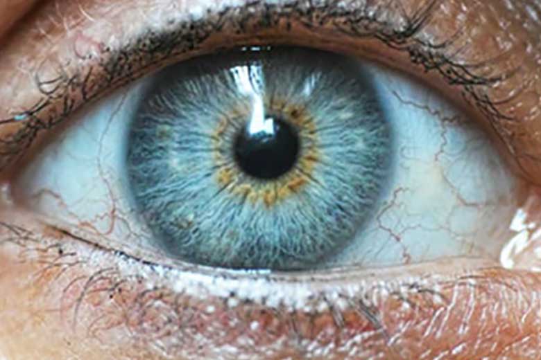 miosis de pupila azul